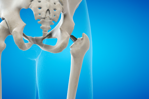 Top Orthopaedic and Joint Replacement Hospital in Patna